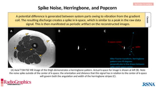 Causes
Spike Noise, Herringbone, and Popcorn
A C
spike
K-space center
After Fourier transform, herringbone
pattern runs 90 degrees
perpendicular to line drawn between
spike and k-space center.
B
(A) Axial T1W FSE MR image of the thigh demonstrates a herringbone pattern. Actual k-space for image is shown at left (B). Note
the noise spike outside of the center of k-space; the orientation and distance that this signal has in relation to the center of k-space
will govern both the angulation and width of the herringbone stripes (C).
A potential difference is generated between system parts owing to vibration from the gradient
coil. The resulting discharge creates a spike in k-space, which is similar to a peak in the raw data
signal. This is then manifested as periodic artifact on the reconstructed images.
RETURN TO INDEX
 