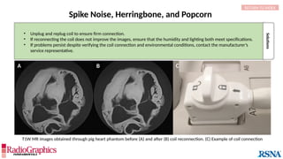 Solutions
Spike Noise, Herringbone, and Popcorn
• Unplug and replug coil to ensure firm connection.
• If reconnecting the coil does not improve the images, ensure that the humidity and lighting both meet specifications.
• If problems persist despite verifying the coil connection and environmental conditions, contact the manufacturer’s
service representative.
A B C
T1W MR images obtained through pig heart phantom before (A) and after (B) coil reconnection. (C) Example of coil connection
RETURN TO INDEX
 