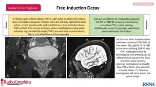 Free-Induction Decay
*
RETURN TO INDEX
Similar to herringbone:
(A) Coronal short inversion-time
inversion-recovery (STIR) MRI of
the pelvis, (B) sagittal T2 FS MRI
of the brain utilizing 3D FSE with
VFA. Although similar to
herringbone, FID artifacts can be
differentiated because the lines
are often wavy (arrows),
whereas herringbone is straight.
Also, FID artifacts stop abruptly
in some places (*), whereas
herringbone will carry across the
entire image.
Causes
Solutions
A B
FID can sometimes be resolved by applying
full 90° or 180° RF pulses and increasing
echo time (TE) or echo spacing.
Additionally, use of ≥2 averages will almost
always eliminate the artifact.
In theory, spin-echoes utilize a 90° or 180° pulse to excite and refocus
spins. In practice, however, if some spins are not fully exposed to both
pulses, errant signal results and manifests as a free-induction decay
(FID) artifact. This is most common when modified refocusing pulse
schemes (eg, variable flip angle [VFA]) are used and in areas where
there is localized tissue inhomogeneity.
 