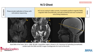 N/2 Ghost
A B
Description
RETURN TO INDEX
Causes
N/2 occurs owing to eddy currents, incomplete gradient magnetic fields,
magnetic field nonuniformity, and odd-numbered and even-numbered
echo timing imbalances.
Phase encode replication of tissue with
echo-planar sequencing.
Axial DWI of the brain, (A) b = 1000, (B) ADC. Acquisition angle is shown in (C). Excessive N/2 ghosting (arrowheads)
renders both the DWI and ADC images nondiagnostic for much of the brain.
 