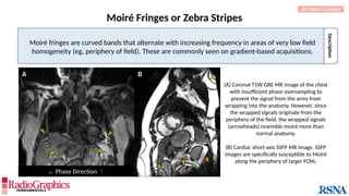 Description
Moiré Fringes or Zebra Stripes
Moiré fringes are curved bands that alternate with increasing frequency in areas of very low field
homogeneity (eg, periphery of field). These are commonly seen on gradient-based acquisitions.
A B
(A) Coronal T1W GRE MR image of the chest
with insufficient phase oversampling to
prevent the signal from the arms from
wrapping into the anatomy. However, since
the wrapped signals originate from the
periphery of the field, the wrapped signals
(arrowheads) resemble moiré more than
normal anatomy.
(B) Cardiac short-axis SSFP MR image. SSFP
images are specifically susceptible to Moiré
along the periphery of larger FOVs.
RETURN TO INDEX
 Phase Direction 
 