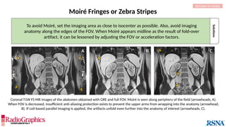 Solutions
Coronal T1W FS MR images of the abdomen obtained with GRE and full FOV. Moiré is seen along periphery of the field (arrowheads, A).
When FOV is decreased, insufficient anti-aliasing protection exists to prevent the upper arms from wrapping into the anatomy (arrowhead,
B). If coil-based parallel imaging is applied, the artifacts unfold even further into the anatomy of interest (arrowheads, C).
Moiré Fringes or Zebra Stripes
To avoid Moiré, set the imaging area as close to isocenter as possible. Also, avoid imaging
anatomy along the edges of the FOV. When Moiré appears midline as the result of fold-over
artifact, it can be lessened by adjusting the FOV or acceleration factors.
A A B C
RETURN TO INDEX
 