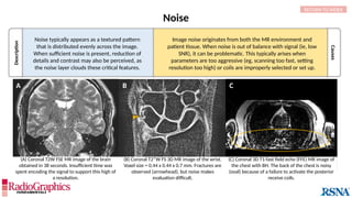 Description
Causes
Noise
Noise typically appears as a textured pattern
that is distributed evenly across the image.
When sufficient noise is present, reduction of
details and contrast may also be perceived, as
the noise layer clouds these critical features.
RETURN TO INDEX
Image noise originates from both the MR environment and
patient tissue. When noise is out of balance with signal (ie, low
SNR), it can be problematic. This typically arises when
parameters are too aggressive (eg, scanning too fast, setting
resolution too high) or coils are improperly selected or set up.
A B C
A B C
(B) Coronal T2*W FS 3D MR image of the wrist.
Voxel size = 0.44 x 0.44 x 0.7 mm. Fractures are
observed (arrowhead), but noise makes
evaluation difficult.
(C) Coronal 3D T1-fast field echo (FFE) MR image of
the chest with BH. The back of the chest is noisy
(oval) because of a failure to activate the posterior
receive coils.
(A) Coronal T2W FSE MR image of the brain
obtained in 38 seconds. Insufficient time was
spent encoding the signal to support this high of
a resolution.
 