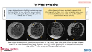 Description
Causes
Axial dataset obtained through calf without contrast agent by T1W 2-point Dixon. (A) In-phase, (B) out-of-phase, (C) water
image, (D) fat image. Swapped fat and water signals are seen in (C) and (D). Note that this correlates with a less obvious
edge artifact (*) in the same area of the opposed-phase image.
Fat-Water Swapping
A D
C
B
* *
*
RETURN TO INDEX
Images obtained by using the Dixon method may swap
the intensities of fat and water after reconstruction. If
the out-of-phase image is also generated, subtle line
artifacts may be visible.
In Dixon-based techniques specifically, magnetic field
inhomogeneity or phase errors in the sampled area can cause
iterative calculation errors, which may result in a false
determination of voxel contents.
 