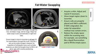 Fat-Water Swapping
A B
Solutions
x-axis; y-axis; z-axis
DSV
gantry
C
patient couch
RETURN TO INDEX
• Acquire a shim. Adjust and
repeat if necessary.
• Move target region closer to
isocenter.
• Ensure coils are properly
placed and SNR is sufficient:
if SNR is degraded, the
water-fat separation
method may contain errors.
• Reduce the empty space
within the scanning area.
For example, use something
like a liquid fluorocarbon
pad to fill the empty space.
Axial T1W 2-point Dixon MR images through the
liver. (A) Water image. (B) Fat image. Major fat-
water swap is seen (arrowheads) in right liver
lobe.
Ensure target is close to isocenter in all axes (C).
For examinations through the trunk, only the z-
axis can be easily changed. However, for
inspection of orthopedic areas such as limbs,
anatomy can often be brought close to DSV in all
three axes with creative positioning.
 