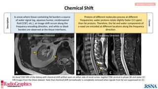  Frequency Direction 
B C
A
 Frequency Direction 
Description
Causes
Chemical Shift
In areas where tissue containing fat borders a source
of water signal (eg, aqueous humor, cerebrospinal
fluid [CSF], etc.), an image shift occurs along the
frequency-encoding direction, and white or black
borders are observed at the tissue interfaces.
(A) Axial T2W MRI of the kidney with chemical shift artifact seen on either side of renal cortex. Sagittal T2W cervical in-phase (B) and water (C)
MR images from the Dixon dataset. Note that chemical shift (arrowheads) is completely removed when signals from fat are suppressed on (C).
RETURN TO INDEX
Protons of different molecules precess at different
frequencies; water protons rotate slightly faster (3.5 ppm)
than fat protons. Therefore, the fat and water components of
a voxel are encoded at different locations along the frequency
direction.
 