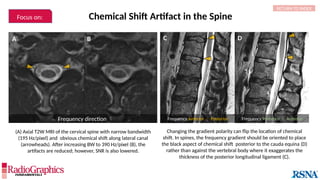 (A) Axial T2W MRI of the cervical spine with narrow bandwidth
(195 Hz/pixel) and obvious chemical shift along lateral canal
(arrowheads). After increasing BW to 390 Hz/pixel (B), the
artifacts are reduced; however, SNR is also lowered.
Chemical Shift Artifact in the Spine
Changing the gradient polarity can flip the location of chemical
shift. In spines, the frequency gradient should be oriented to place
the black aspect of chemical shift posterior to the cauda equina (D)
rather than against the vertebral body where it exaggerates the
thickness of the posterior longitudinal ligament (C).
B
A
 Frequency direction  Frequency Anterior  Posterior Frequency Posterior  Anterior
C D
RETURN TO INDEX
Focus on:
 
