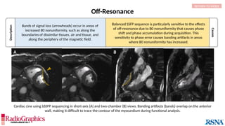 Description
Causes
Off-Resonance
Bands of signal loss (arrowheads) occur in areas of
increased B0 nonuniformity, such as along the
boundaries of dissimilar tissues, air and tissue, and
along the periphery of the magnetic field.
RETURN TO INDEX
Cardiac cine using bSSFP sequencing in short-axis (A) and two-chamber (B) views. Banding artifacts (bands) overlap on the anterior
wall, making it difficult to trace the contour of the myocardium during functional analysis.
A B
Balanced SSFP sequence is particularly sensitive to the effects
of off-resonance due to B0 nonuniformity that causes phase
shift and phase accumulation during acquisition. This
sensitivity to phase error causes banding artifacts in areas
where B0 nonuniformity has increased.
 