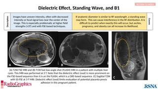 Description
Causes
A B
Dielectric Effect, Standing Wave, and B1
(A) T2W FSE MRI and (B) T1W fast low-angle shot (FLASH) MRI in a patient with multiple liver
cysts. This MRI was performed at 3 T. Note that the dielectric effect (oval) is more prominent on
the FSE-based sequence than it is on the FLASH, which is a GRE-based sequence. (C) Sagittal T2W
with SS-FSE at 3-T MRI. Dielectric effect (oval) limits evaluation of potential placenta previa
adhesion in this pregnant patient.
RETURN TO INDEX
Images have uneven intensity, often with decreased
intensity or focal signal loss near the center of the
image. This is especially problematic at higher field
strengths (≥3T) and with FSE-based techniques.
If anatomic diameter is similar to RF wavelength, a standing wave
may form. This can cause interference in the RF distribution. It is
difficult to predict when exactly this will occur, but ascites,
pregnancy, and obesity can all increase its likelihood.
C
 