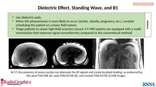 A B C
Solutions
• Use dielectric pads.
• When this phenomenon is more likely to occur (ascites, obesity, pregnancy, etc.), consider
scheduling the patient on a lower field system.
• Triage patients to newer high-field scanners (recent 3-T MRI systems are equipped with a multi-
transmission that improves signal nonuniformity compared to the conventional method)
Dielectric Effect, Standing Wave, and B1
RETURN TO INDEX
At 3 T, the presence of severe ascites can attenuate the RF signals and create localized shading, as evidenced by
this axial T1W GRE (A), axial T2W SS-FSE (B), and coronal T2W SS-FSE (C) MR images.
 