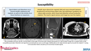 Description
Causes
Susceptibility
A B C
* D
Signal defects and distortions occur
around metallic substances and
implants, as well as in the vicinity of air-
tissue interfaces on sequences.
RETURN TO INDEX
Metallic items disturb the magnetic field and cause mismatch between
broadcast RF and local tissue signal. Also, fast switching of gradients can
induce eddy currents, which cause local distortion around conductive
implants. The result is signal variance and image loss near the implant.
Axial T1W SE MR image of the brain in a patient with an MR-compatible ventriculoperitoneal (VP) shunt (A). Source image for brain MRA in a patient with an
MR-compatible aneurysm clip (B). Coronal PDW FS MR image of the knee after surgical intervention (C). SSFP localizer image (D) in a patient with an MR-
compatible pacemaker. Distortion and signal loss (arrowheads) are seen on all images. Additionally on (C), high-intensity signal surrounds the implant (*) owing
to fat saturation failure and pile-up of incorrectly encoded signals.
 