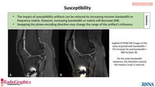 A B
Susceptibility
Sagittal FS PDW MR images of the
knee acquired with bandwidth =
195 Hz/pixel (A) and bandwidth =
488 Hz/pixel (B).
On the wide-bandwidth
sequence, the distortion around
the implant (oval) is reduced.
Solutions
• The impact of susceptibility artifacts can be reduced by increasing receiver bandwidth or
frequency matrix. However, increasing bandwidth or matrix will decrease SNR.
• Swapping the phase-encoding direction may change the range of the artifact’s influence.
RETURN TO INDEX
 