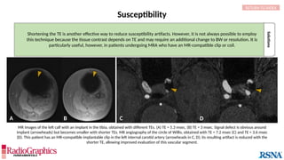 Susceptibility
Solutions
Shortening the TE is another effective way to reduce susceptibility artifacts. However, it is not always possible to employ
this technique because the tissue contrast depends on TE and may require an additional change to BW or resolution. It is
particularly useful, however, in patients undergoing MRA who have an MR-compatible clip or coil.
RETURN TO INDEX
C D
B
A
MR images of the left calf with an implant in the tibia, obtained with different TEs. (A) TE = 5.3 msec, (B) TE = 3 msec. Signal defect is obvious around
implant (arrowheads) but becomes smaller with shorter TEs. MR angiography of the circle of Willis, obtained with TE = 7.2 msec (C) and TE = 3.6 msec
(D). This patient has an MR-compatible implantable clip in the left internal carotid artery (arrowheads in C, D); its resulting artifact is reduced with the
shorter TE, allowing improved evaluation of this vascular segment.
 