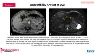 Susceptibility Artifact at DWI
Abdominal section at the level of the pancreas was obtained with a 3-T scanner. (A) T1W (opposed phase), (B) DWI (b = 1500).
Gas in the stomach, small intestine, and colon may reduce the signal of surrounding tissues or cause distortion on the diffusion-
weighted image. In this case, the signal around the pancreas body (arrowheads in B) was lost owing to gas in the transverse colon
(oval in A). It is recommended to prescribe fasting and an enema before the examination. Distortion can be reduced by decreasing
the phase FOV or the number of frequency matrix.
A B
RETURN TO INDEX
Focus on:
 