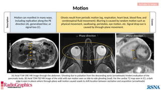 Description
Causes
Motion
Motion can manifest in many ways,
including replication along the PE
direction (A), generalized blur, or
signal loss (C).
(A) Axial T1W GRE MR image through the abdomen. Ghosting due to pulsation from the descending aorta (arrowheads) hinders evaluation of the
pancreatic body. (B) Axial T2W FSE MR image of the orbit with eye motion seen as side-to-side ghosting (oval). For the cardiac T2 map seen in (C), a dark
edge is seen in places where through-plane wall motion caused voxels to shift location between excitation and acquisition (arrowheads)
RETURN TO INDEX
Ghosts result from periodic motion (eg, respiration, heart beat, blood flow, and
cerebrospinal fluid movement). Blurring is caused by random motion such as
physical movement, swallowing, peristalsis, eye motion, etc. Signal drop-out is
caused by through-plane movement.
C
A B

Phase
direction

 Phase direction   Phase direction 
 