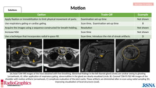 Baseline C D
A B
Motion
Solutions
RETURN TO INDEX

Phase
direction

(A) Axial T2W MR images of the neck obtained with free breathing. Abnormal findings in the left thyroid gland (circle) are unclear owing to ghosting
(arrowheads, A). After application of respiratory gating, abnormalities in the gland are clearly visualized (circle, B). Coronal T2W FS FSE MR images of the
shoulder with motion artifacts (arrowheads, C) complicate evaluation of the joint cavity. These artifacts are diminished after re-scan using radial sampling (D),
improving visualization of local structures (oval).
Option Trade-Off Example
Apply fixation or immobilization to limit physical movement of parts. Examination set-up time Not shown
Use respiratory gating or cardiac gating. Scan time, Examination set-up time B
Acquire the images using a sequence constructed for breath-holding. Resolution Not shown
Increase NSA Scan time Not shown
Use a technique that incorporates radial k-space fill. Scan time, introduce the risk of streak artifacts. D
 