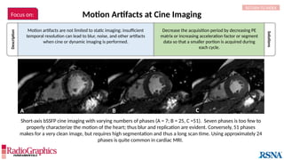 Short-axis bSSFP cine imaging with varying numbers of phases (A = 7; B = 25, C =51). Seven phases is too few to
properly characterize the motion of the heart; thus blur and replication are evident. Conversely, 51 phases
makes for a very clean image, but requires high segmentation and thus a long scan time. Using approximately 24
phases is quite common in cardiac MRI.
Motion Artifacts at Cine Imaging
A B C
Description
Motion artifacts are not limited to static imaging; insufficient
temporal resolution can lead to blur, noise, and other artifacts
when cine or dynamic imaging is performed.
Solutions
Decrease the acquisition period by decreasing PE
matrix or increasing acceleration factor or segment
data so that a smaller portion is acquired during
each cycle.
RETURN TO INDEX
Focus on:
 