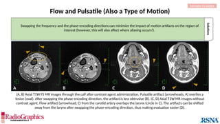 A B D
C
Solutions
Swapping the frequency and the phase-encoding directions can minimize the impact of motion artifacts on the region of
interest (however, this will also affect where aliasing occurs!).
Flow and Pulsatile (Also a Type of Motion)
(A, B) Axial T1W FS MR images through the calf after contrast agent administration. Pulsatile artifact (arrowheads, A) overlies a
lesion (oval). After swapping the phase-encoding direction, the artifact is less obtrusive (B). (C, D) Axial T1W MR images without
contrast agent. Flow artifact (arrowhead, C) from the carotid artery overlaps the larynx (circle in C). The artifacts can be shifted
away from the larynx after swapping the phase-encoding direction, thus making evaluation easier (D).
RETURN TO INDEX
 