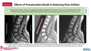 Effects of Presaturation Bands in Reducing Flow Artifact
A

Phase
direction

B
P
R
E
S
A
T
U
R
A
T
I
O
N
B
A
N
D
Focus on:
Solutions
In-plane flow artifact can also be mitigated by adding spatial presaturation over the source of the flow (this has the
trade-off of increasing SAR) or making adjustments to sequence parameters (such as shorter ETS, shorter TE, etc.)
(A) Sagittal T1W MR images of the lumbar spine. Strong flow artifact (arrowheads) from the descending aorta obfuscates much of T12 and L1 and
portions of the cauda equina. Repeat MRI performed with a presaturation band on the abdominal aorta (B) diminishes these flow artifacts.
 