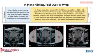 Causes
In-Plane Aliasing, Fold-Over, or Wrap
RETURN TO INDEX
Description
 Phase Encoding 
0◦
+90◦
-90◦
+180◦
-180◦
 Total anatomy exposed to RF 
Left
Hip
-90◦
+90◦
Left
Hip
-90◦
-90◦
+90◦
-90◦
Resulting Image with aliasing
Right
Hip
A B C
When aliasing occurs, anatomy
outside of the FOV appears on the
final image. On modern scanners,
in-plane aliasing is typically only
problematic in the phase direction.
In the phase direction, signals within the FOV are encoded from –180 to +180
degrees (A). However, radiofrequency does not abruptly stop at the edges of the
FOV. This means if anatomy exists outside of the phase FOV, it is also excited.
However, since the same phase-encoding steps are simply repeated outside of the
FOV, the position of any tissue outside of the FOV will match the phase encoding
of value of areas within the FOV (C), and aliasing of those signals will occur (B).
 