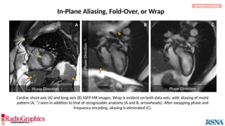 Cardiac short-axis (A) and long-axis (B) SSFP MR images. Wrap is evident on both data sets, with aliasing of moiré
pattern (A, *) seen in addition to that of recognizable anatomy (A and B, arrowheads). After swapping phase and
frequency encoding, aliasing is eliminated (C).
In-Plane Aliasing, Fold-Over, or Wrap
RETURN TO INDEX
A B C
*
*
 Phase Direction 

Phase
Direction

 Phase Direction 
 