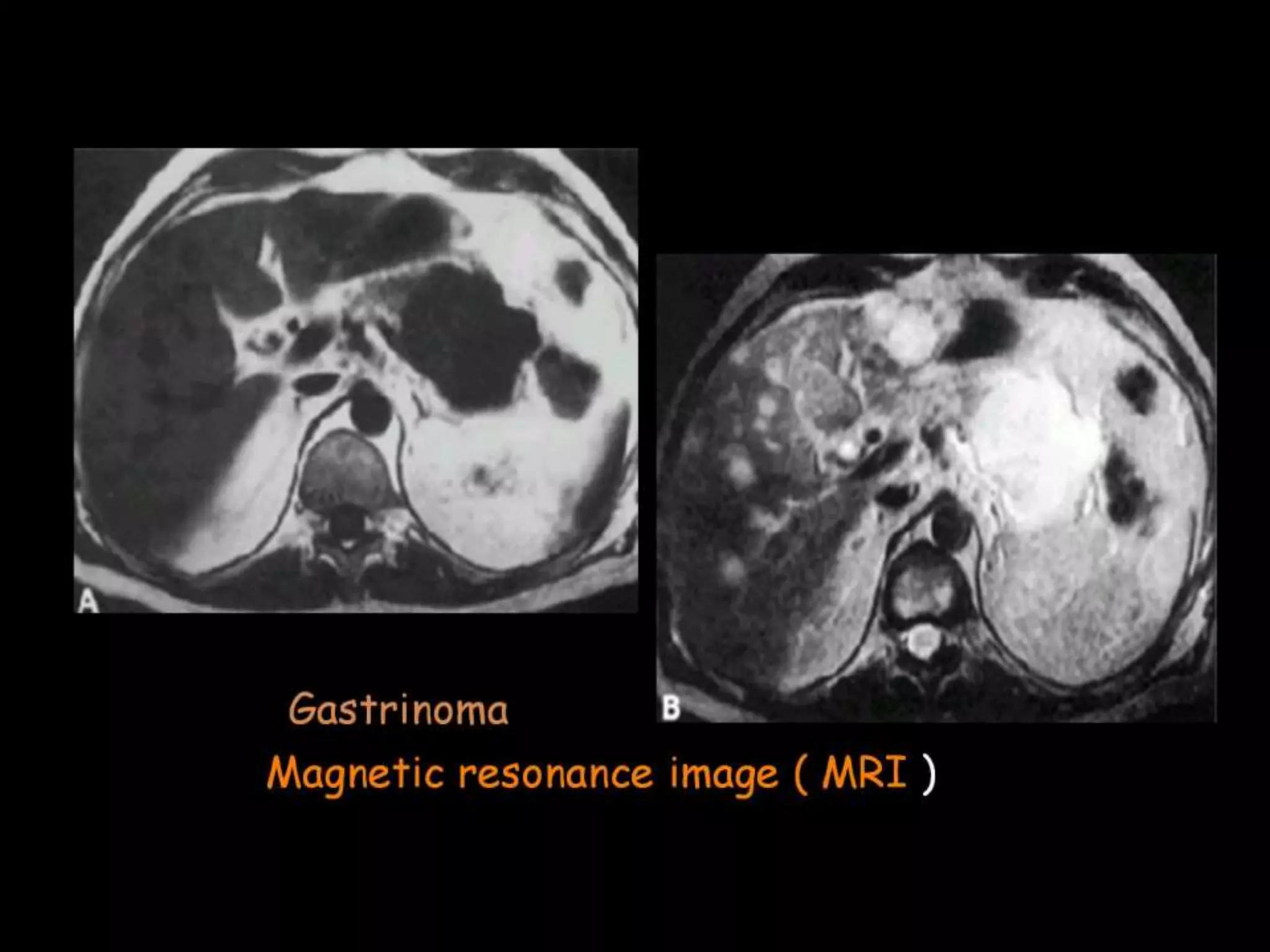 42-Dr Ahmed Esawy imaging oral board of splenic peritoneum imaging ...