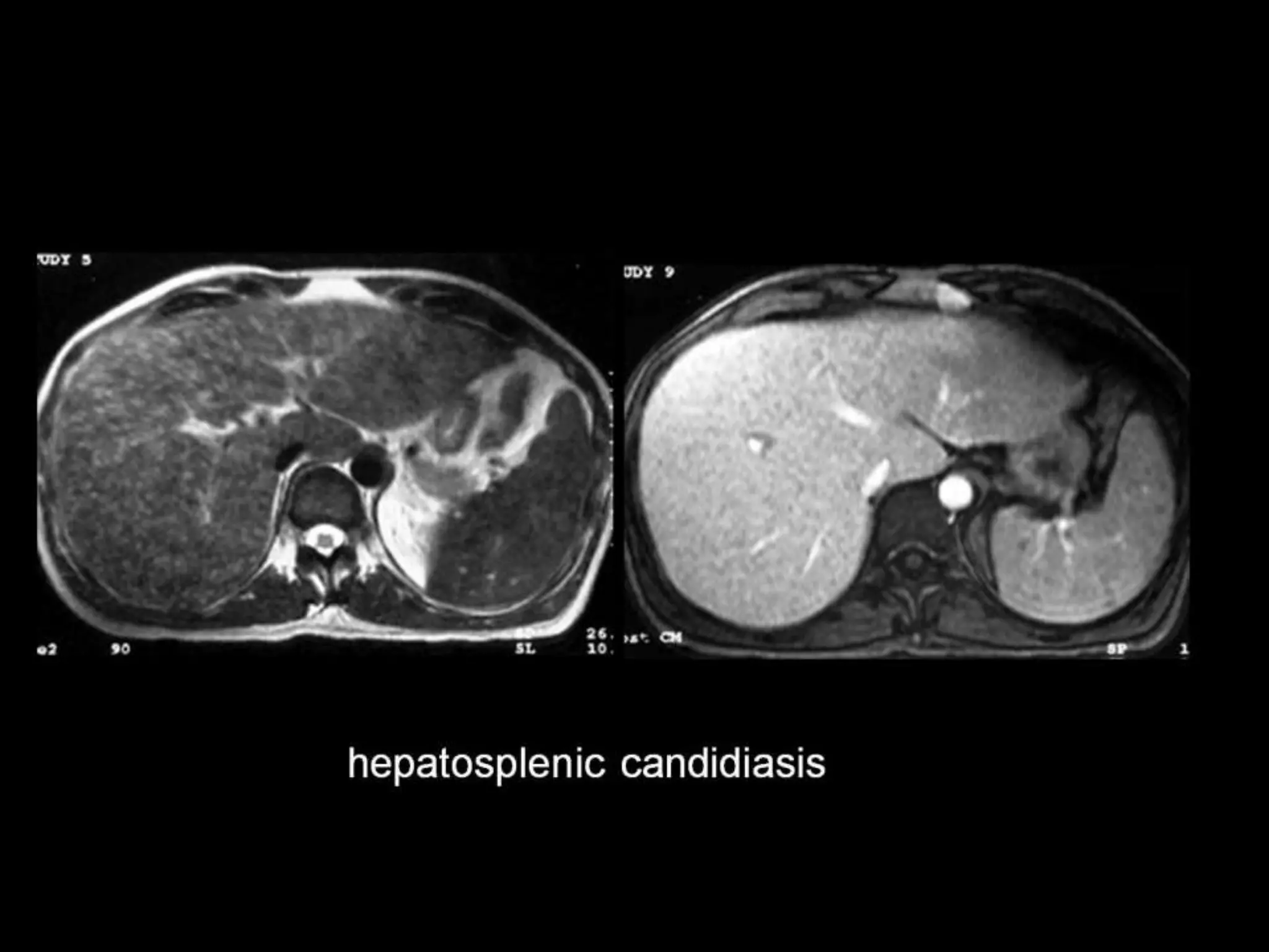 42-Dr Ahmed Esawy imaging oral board of splenic peritoneum imaging | PPT