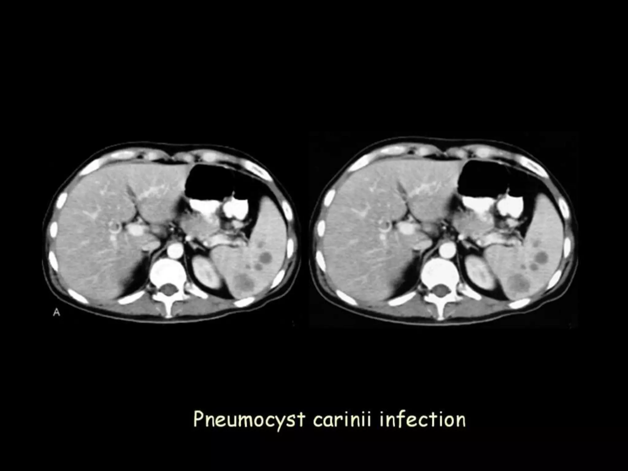 42-Dr Ahmed Esawy imaging oral board of splenic peritoneum imaging ...