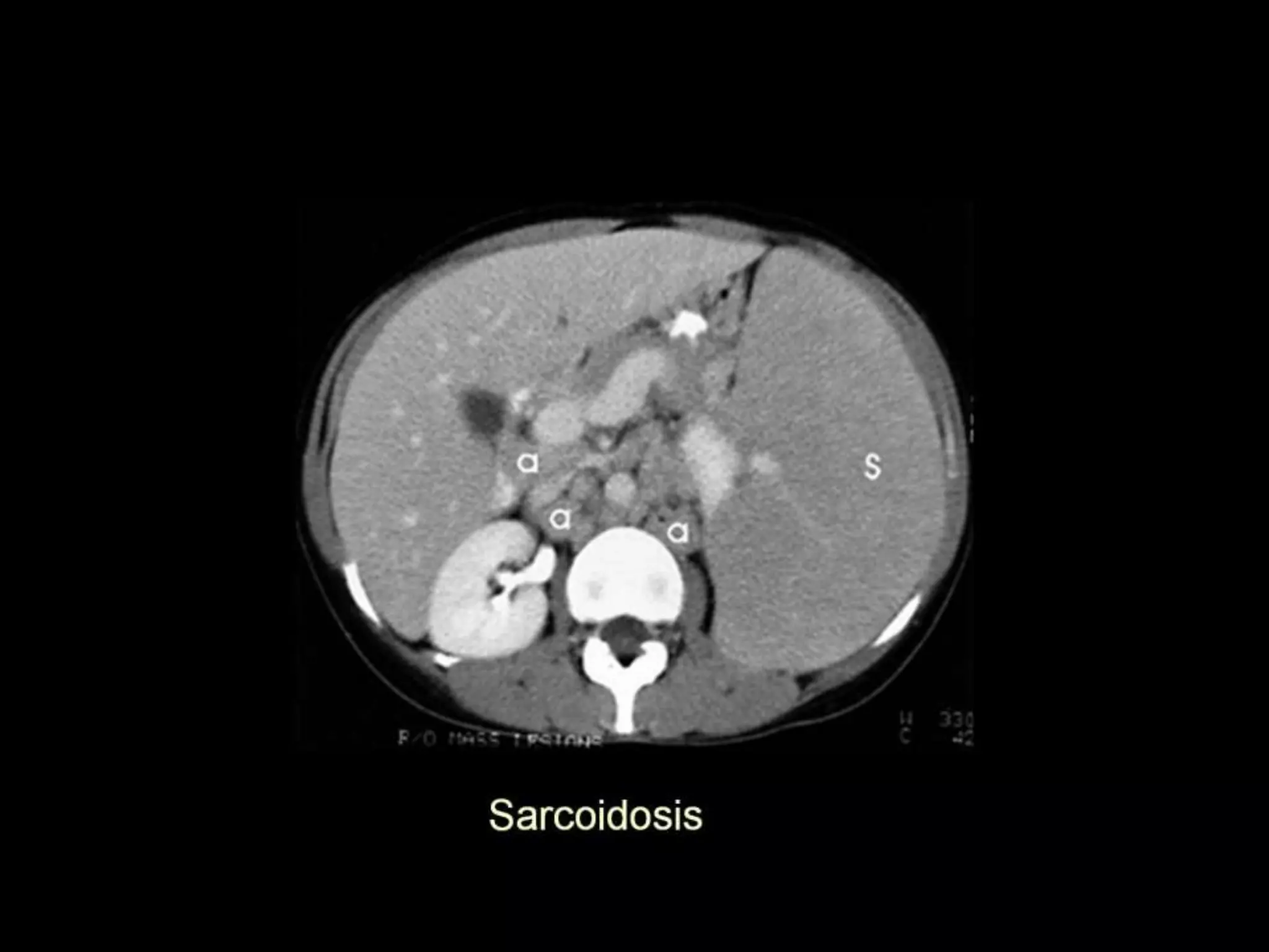 42-Dr Ahmed Esawy imaging oral board of splenic peritoneum imaging ...