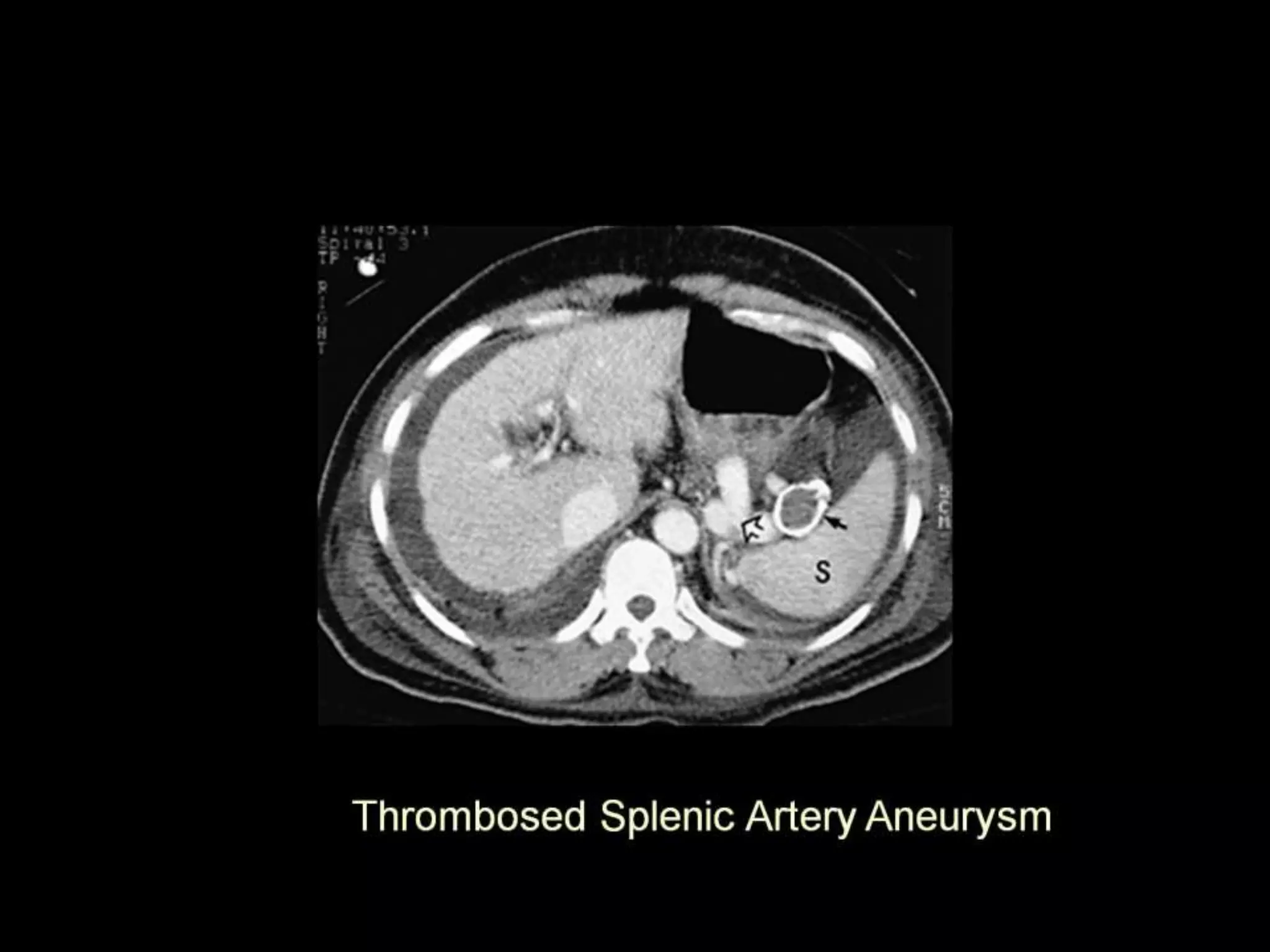 42-Dr Ahmed Esawy imaging oral board of splenic peritoneum imaging ...