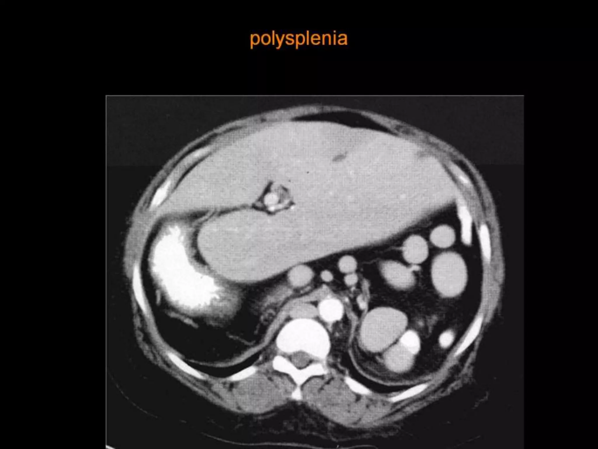 42-Dr Ahmed Esawy imaging oral board of splenic peritoneum imaging ...
