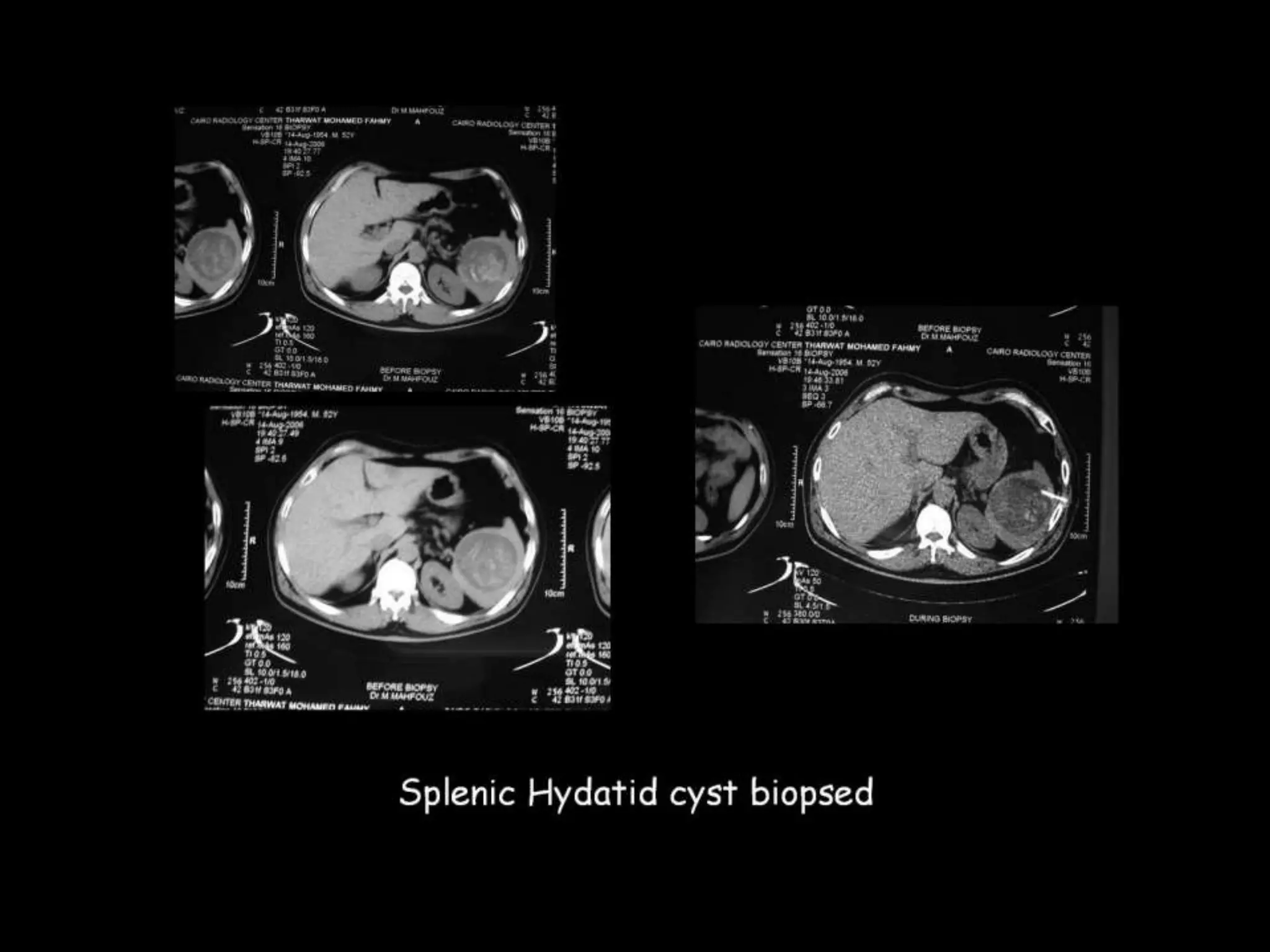 42-Dr Ahmed Esawy imaging oral board of splenic peritoneum imaging | PPT