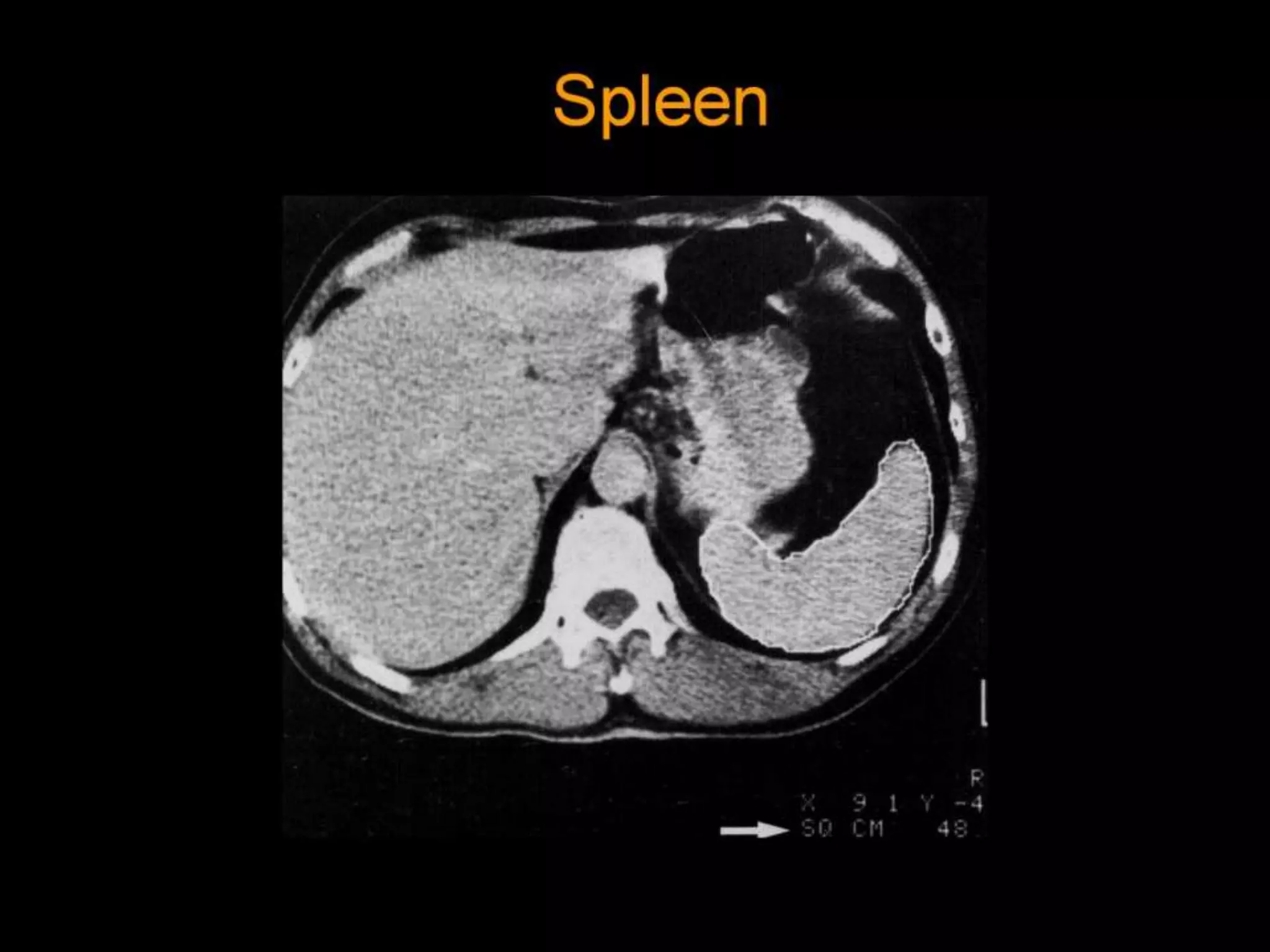 42-Dr Ahmed Esawy imaging oral board of splenic peritoneum imaging | PPT
