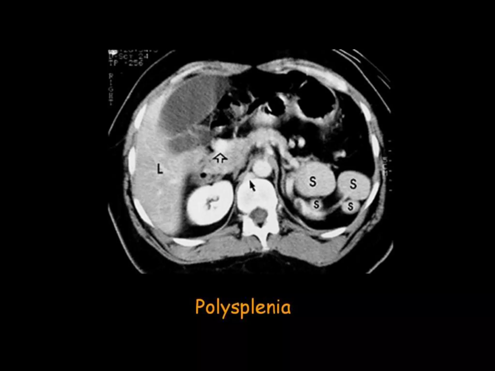 42-Dr Ahmed Esawy imaging oral board of splenic peritoneum imaging | PPT