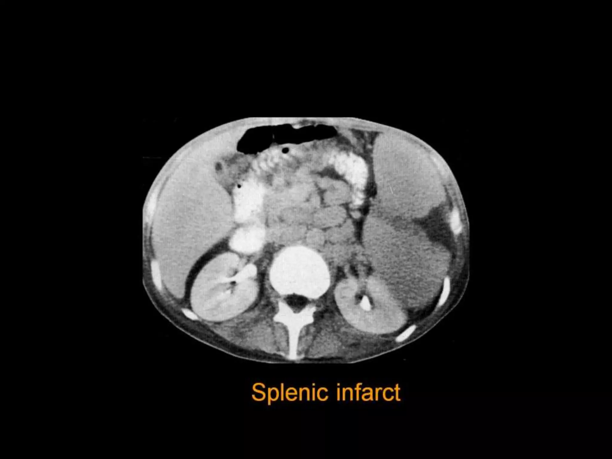 42-Dr Ahmed Esawy imaging oral board of splenic peritoneum imaging | PPT