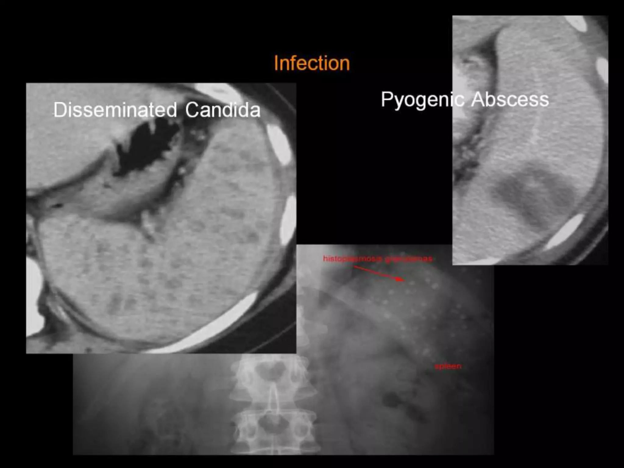 42-Dr Ahmed Esawy imaging oral board of splenic peritoneum imaging ...