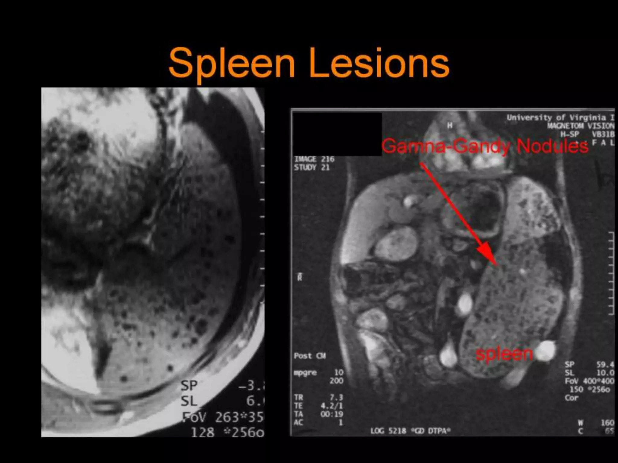 42-Dr Ahmed Esawy imaging oral board of splenic peritoneum imaging ...