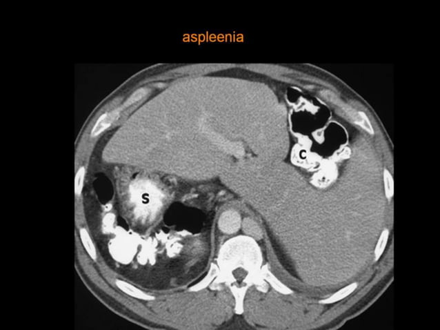 42-Dr Ahmed Esawy imaging oral board of splenic peritoneum imaging ...
