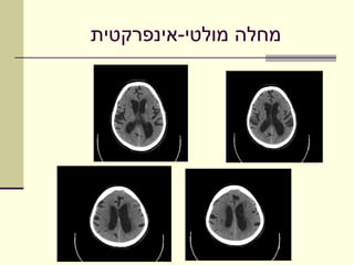 ‫מחלה מולטי-אינפרקטית‬
 