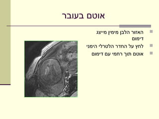 ‫אוטם בעובר‬
          ‫האזור הלבן מימין מייצג‬   ‫‪‬‬
                           ‫דימום‬
     ‫לחץ על החדר הלטרלי הימני‬      ‫‪‬‬
        ‫אוטם תוך רחמי עם דימום‬     ‫‪‬‬
 