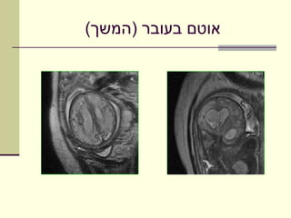 ‫אוטם בעובר )המשך(‬
 