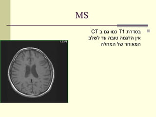‫‪MS‬‬
  ‫בסדרת 1‪ T‬כמו גם ב ‪CT‬‬    ‫‪‬‬
 ‫אין הדגמה טובה עד לשלב‬
      ‫המאוחר של המחלה‬
 