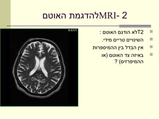 ‫2 -‪MRI‬להדגמת האוטם‬
             ‫2‪T‬לא הודגם האוטם :‬       ‫‪‬‬
               ‫השינויים טריים מידי.‬   ‫‪‬‬
          ‫אין הבדל בין ההמיספרות‬      ‫‪‬‬
              ‫באיזה צד האוטם )או‬      ‫‪‬‬
                     ‫ההמיפרזיס( ?‬
 