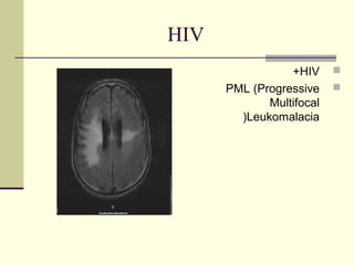HIV
                 +HIV     
      PML (Progressive    
             Multifocal
        )Leukomalacia
 