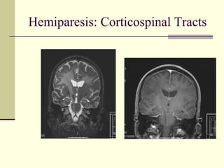 Hemiparesis: Corticospinal Tracts
 