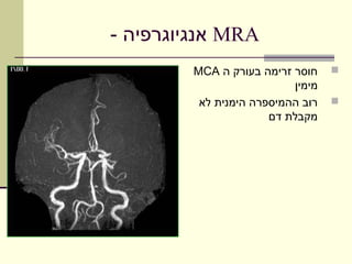 ‫‪ MRA‬אנגיוגרפיה -‬
        ‫חוסר זרימה בעורק ה ‪MCA‬‬    ‫‪‬‬
                          ‫מימין‬
         ‫רוב ההמיספרה הימנית לא‬   ‫‪‬‬
                      ‫מקבלת דם‬
 