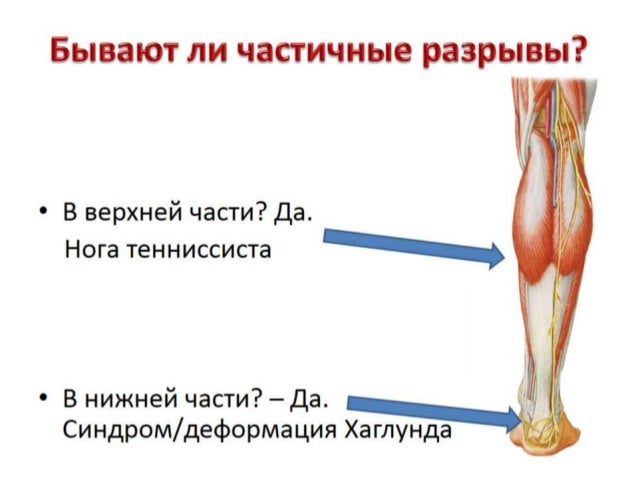 Мышцы участвующие в образовании ахиллова сухожилия. Пластика ахиллова сухожилия. заболевание ахиллова сухожилия. ущемление ахиллова сухожилия. ущемление ахиллова сухожилия самбо.