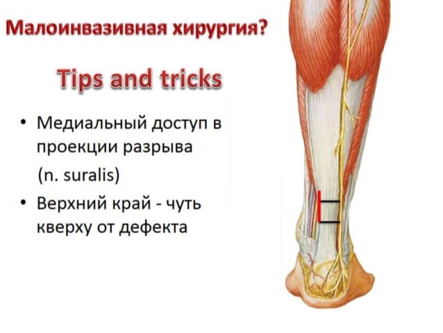Гипс ахиллова сухожилия. Укорочение ахиловогг скожития. Укороченное ахиллово сухожилие. Сшивание ахиллова сухожилия. У ребенка укорочение ахиллова сухожилия.