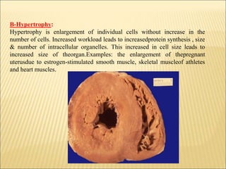 B-Hypertrophy:
Hypertrophy is enlargement of individual cells without increase in the
number of cells. Increased workload leads to increasedprotein synthesis , size
& number of intracellular organelles. This increased in cell size leads to
increased size of theorgan.Examples: the enlargement of thepregnant
uterusdue to estrogen-stimulated smooth muscle, skeletal muscleof athletes
and heart muscles.
 