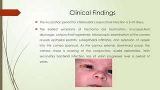 Clinical Findings
 The incubation period for chlamydial conjunctival infection is 3–10 days.
 The earliest symptoms of trachoma are lacrimation, mucopurulent
discharge, conjunctival hyperemia. Microscopic examination of the cornea
reveals epithelial keratitis, subepithelial infiltrates, and extension of vessels
into the cornea (pannus). As the pannus extends downward across the
cornea, there is scarring of the conjunctiva, eyelid deformities. With
secondary bacterial infection, loss of vision progresses over a period of
years.
 